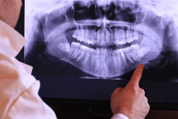 Best Emergency Wisdom Teeth Removal in Forestville, OH